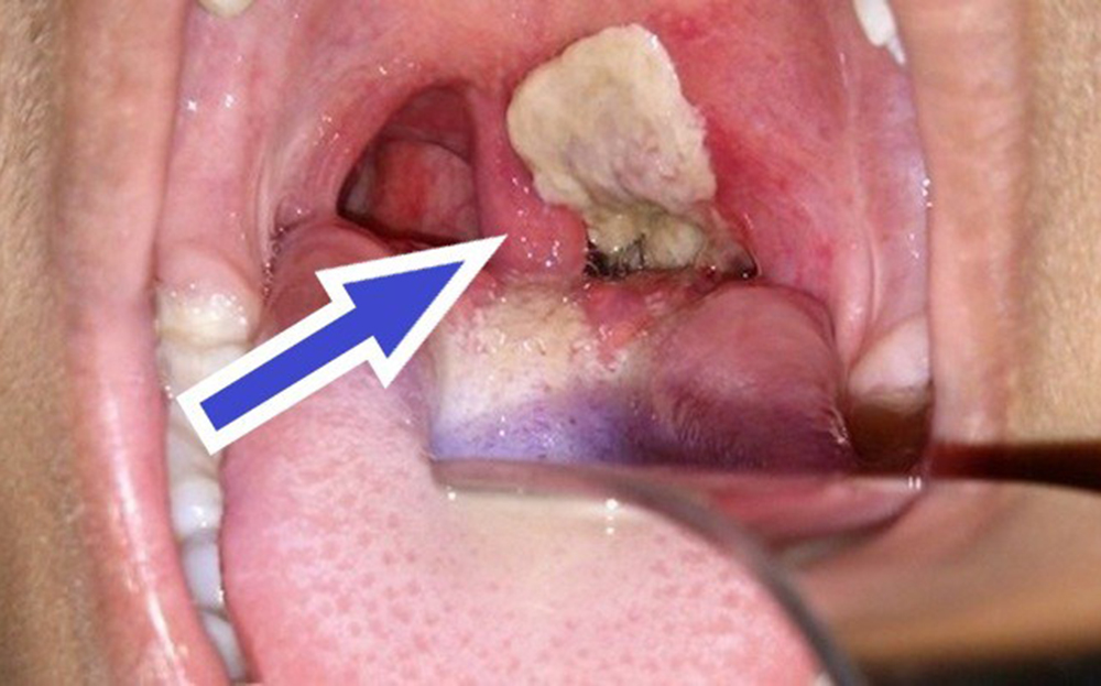 người lớn có cần tiêm vắc xin bạch hầu