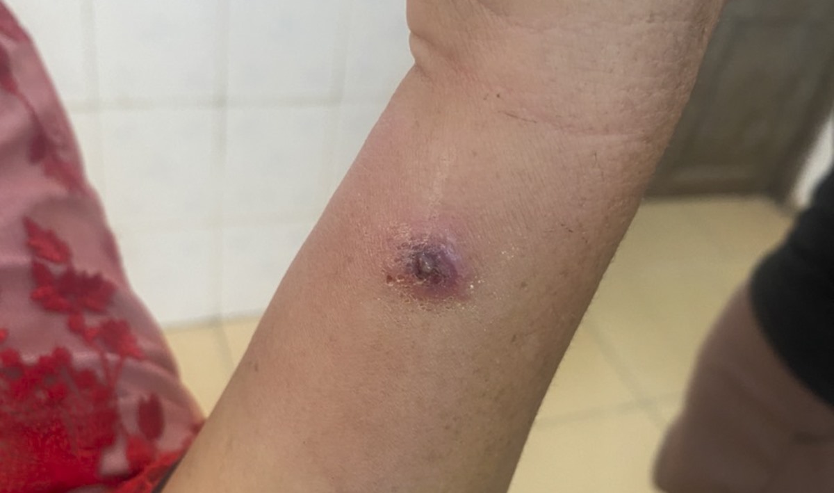 Bệnh than là gì?