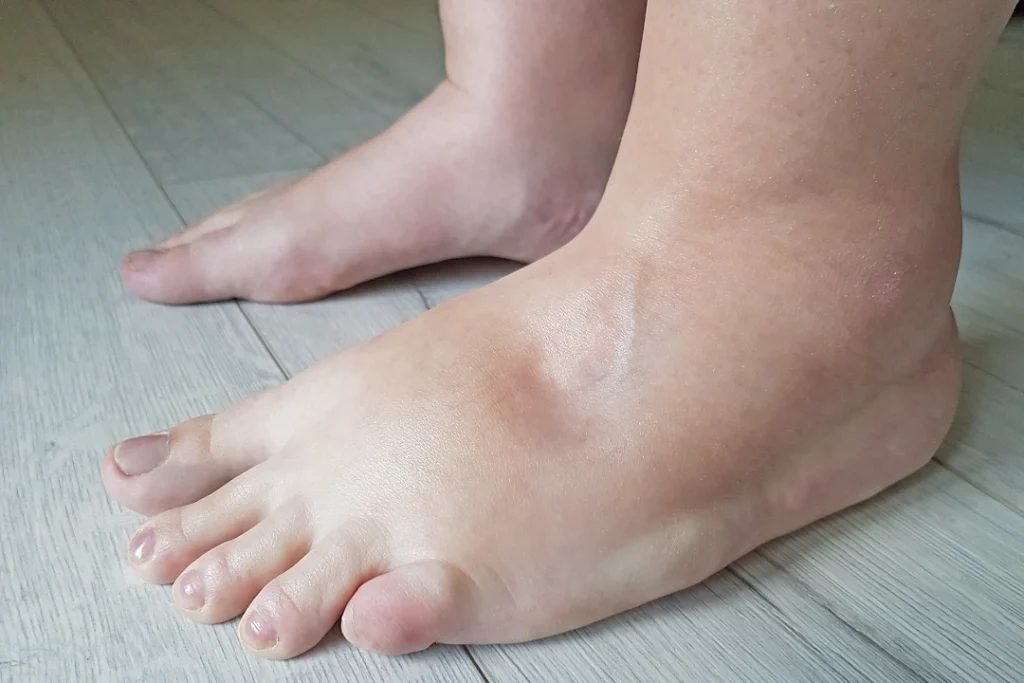 hệ miễn dịch suy yếu